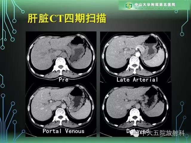【PPT】肝癌高危患者肝脏结节影像学诊断