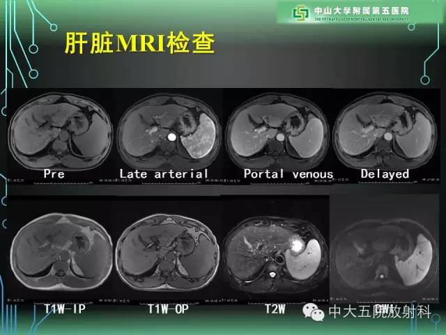【PPT】肝癌高危患者肝脏结节影像学诊断