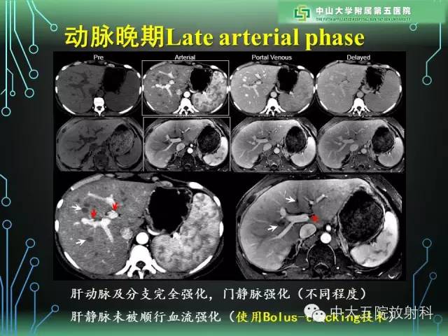 【PPT】肝癌高危患者肝脏结节影像学诊断