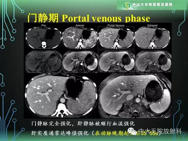 【PPT】肝癌高危患者肝脏结节影像学诊断