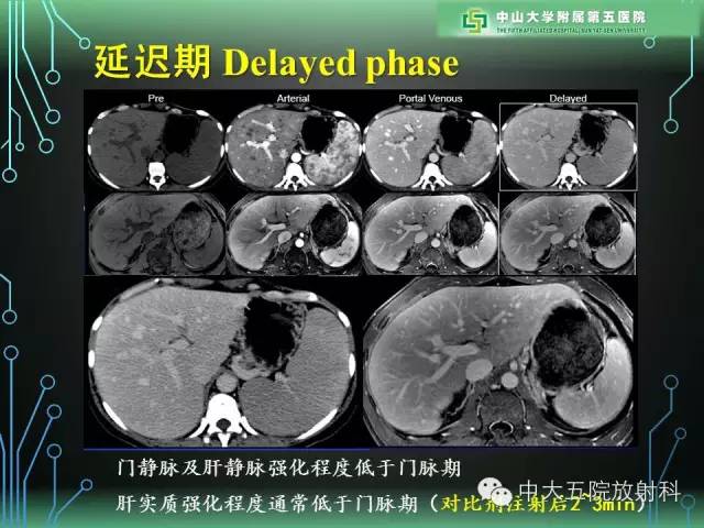 【PPT】肝癌高危患者肝脏结节影像学诊断