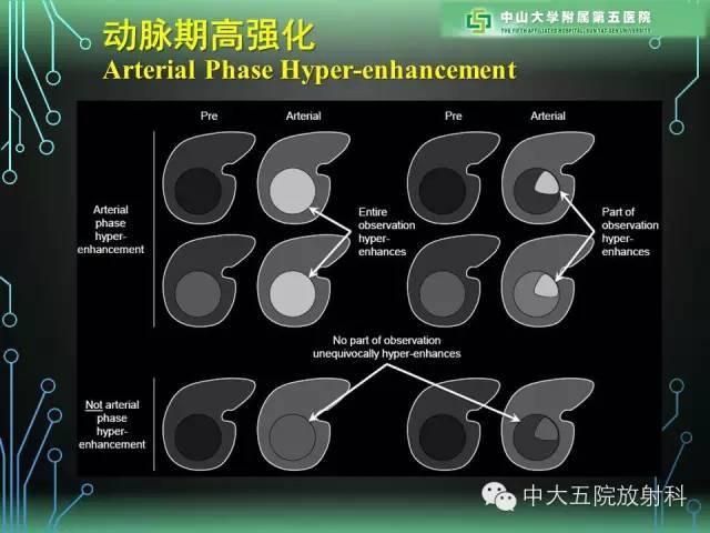 【PPT】肝癌高危患者肝脏结节影像学诊断