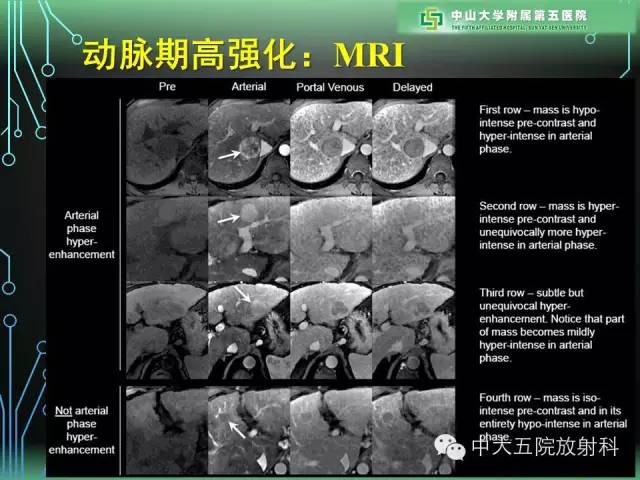 【PPT】肝癌高危患者肝脏结节影像学诊断