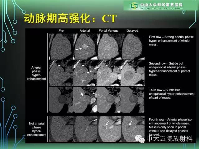 【PPT】肝癌高危患者肝脏结节影像学诊断