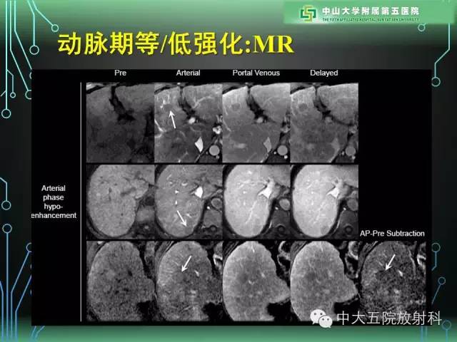 【PPT】肝癌高危患者肝脏结节影像学诊断