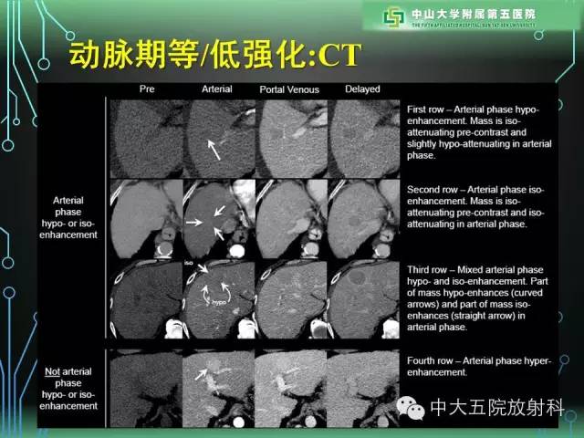 【PPT】肝癌高危患者肝脏结节影像学诊断