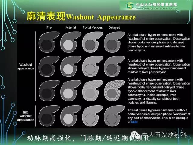 【PPT】肝癌高危患者肝脏结节影像学诊断
