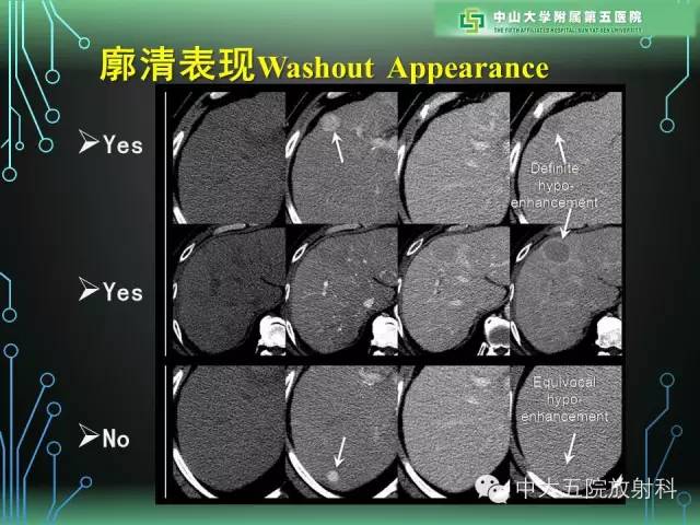 【PPT】肝癌高危患者肝脏结节影像学诊断