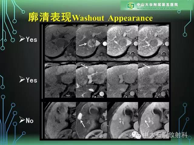 【PPT】肝癌高危患者肝脏结节影像学诊断