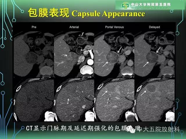 【PPT】肝癌高危患者肝脏结节影像学诊断