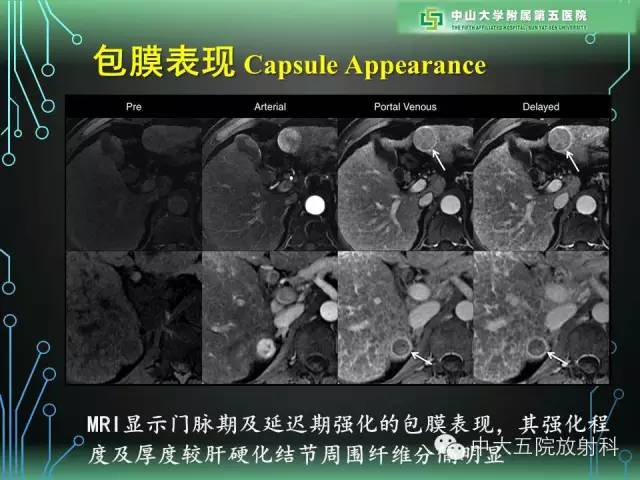 【PPT】肝癌高危患者肝脏结节影像学诊断