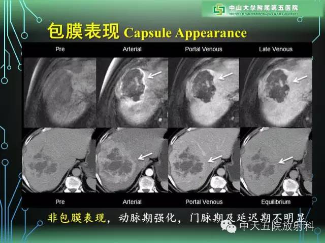【PPT】肝癌高危患者肝脏结节影像学诊断
