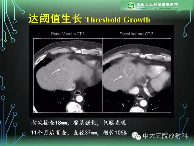 【PPT】肝癌高危患者肝脏结节影像学诊断