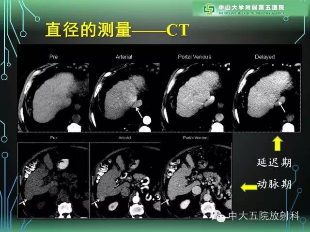 【PPT】肝癌高危患者肝脏结节影像学诊断