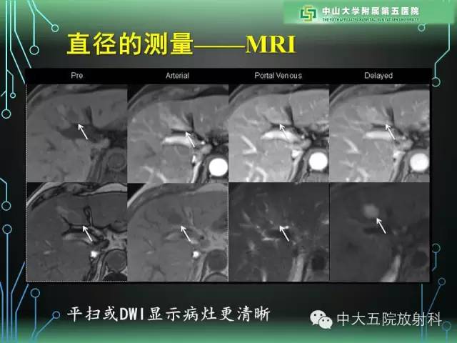 【PPT】肝癌高危患者肝脏结节影像学诊断