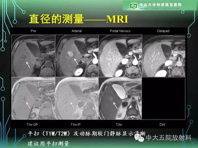 【PPT】肝癌高危患者肝脏结节影像学诊断