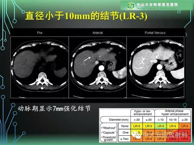 【PPT】肝癌高危患者肝脏结节影像学诊断