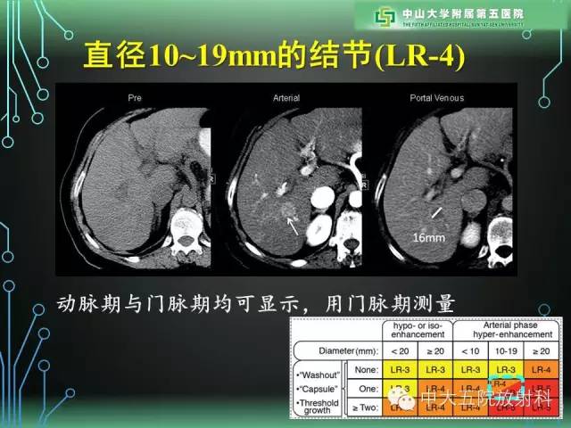 【PPT】肝癌高危患者肝脏结节影像学诊断