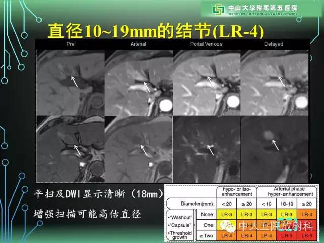 【PPT】肝癌高危患者肝脏结节影像学诊断