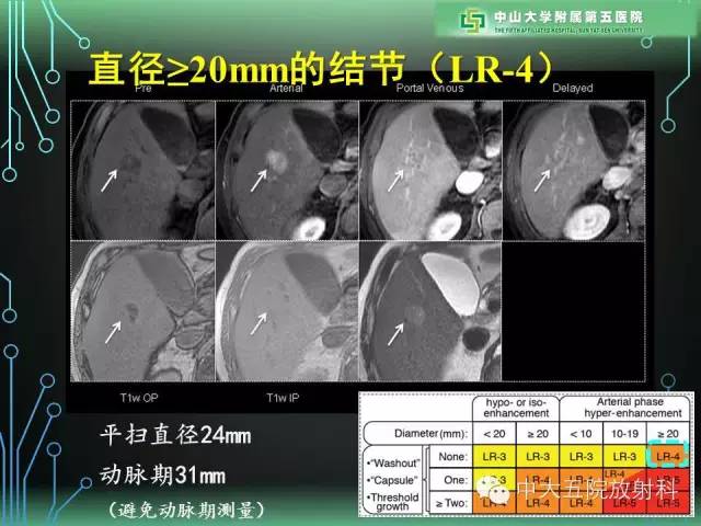 【PPT】肝癌高危患者肝脏结节影像学诊断