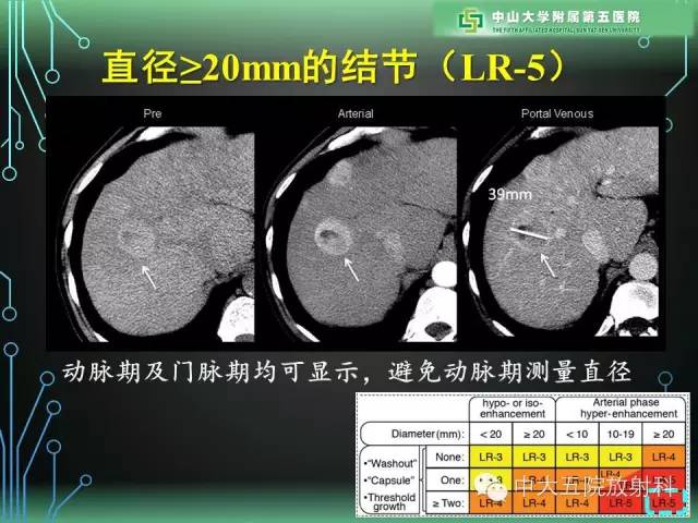 【PPT】肝癌高危患者肝脏结节影像学诊断