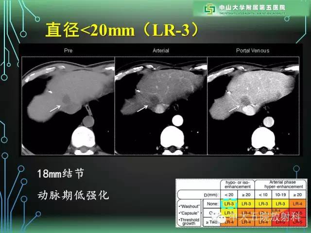 【PPT】肝癌高危患者肝脏结节影像学诊断