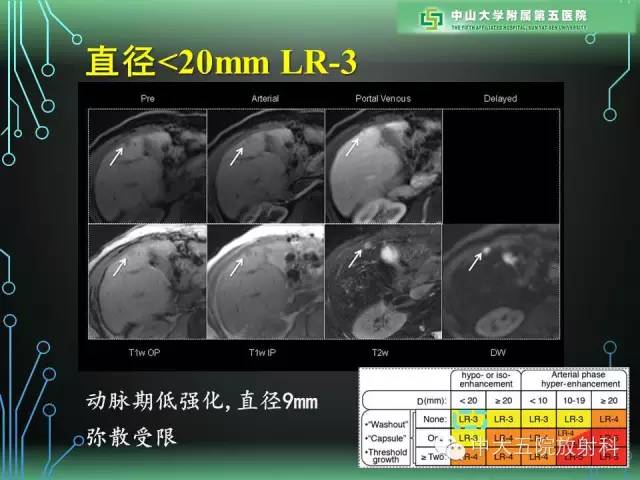 【PPT】肝癌高危患者肝脏结节影像学诊断