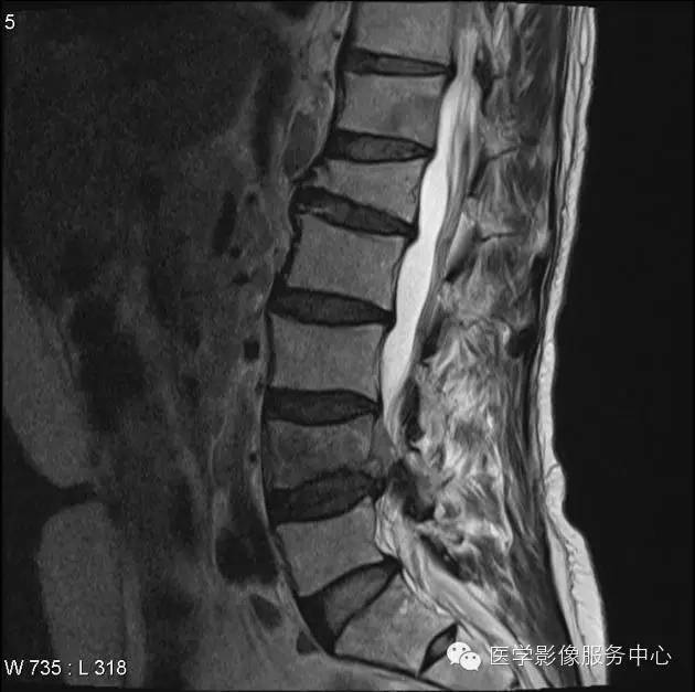 【病例】脊柱淋巴瘤1例MR影像表现 【病例】脊柱淋巴瘤1例MR影像表现