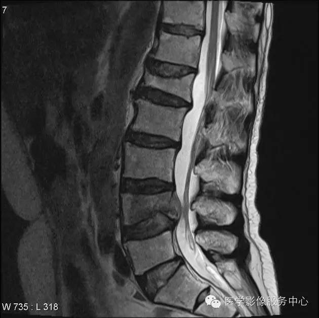 【病例】脊柱淋巴瘤1例MR影像表现 【病例】脊柱淋巴瘤1例MR影像表现