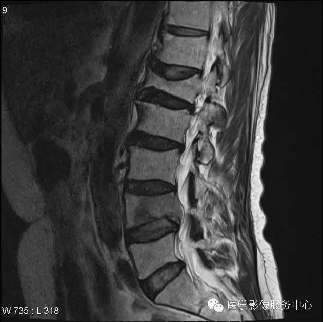 【病例】脊柱淋巴瘤1例MR影像表现 【病例】脊柱淋巴瘤1例MR影像表现