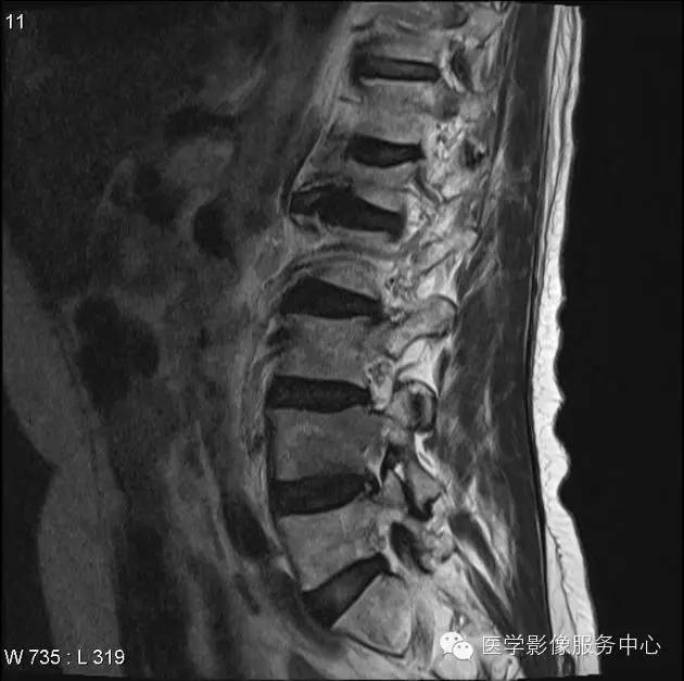 【病例】脊柱淋巴瘤1例MR影像表现 【病例】脊柱淋巴瘤1例MR影像表现