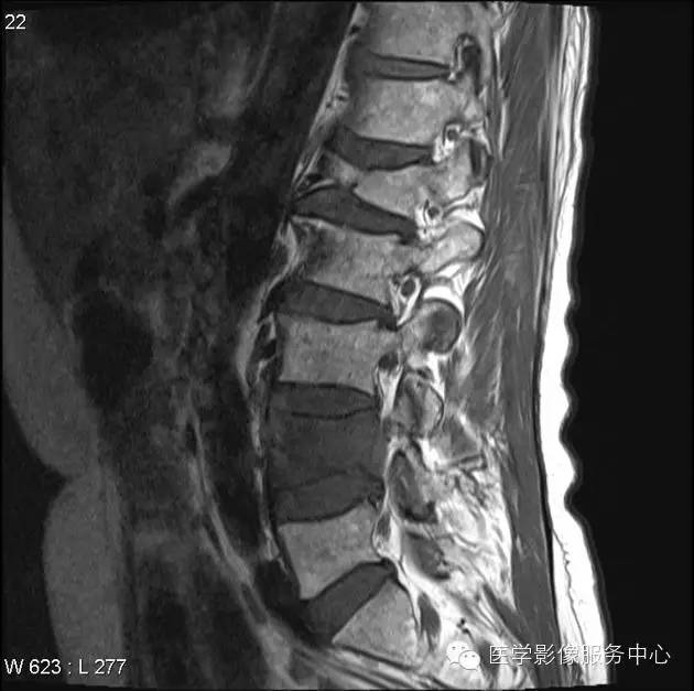 【病例】脊柱淋巴瘤1例MR影像表现 【病例】脊柱淋巴瘤1例MR影像表现