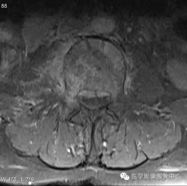【病例】脊柱淋巴瘤1例MR影像表现 【病例】脊柱淋巴瘤1例MR影像表现