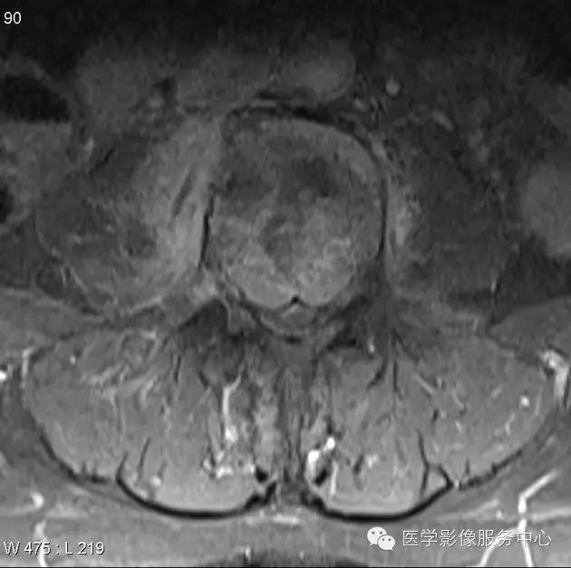 【病例】脊柱淋巴瘤1例MR影像表现 【病例】脊柱淋巴瘤1例MR影像表现