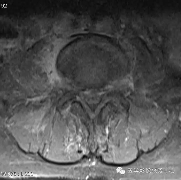 【病例】脊柱淋巴瘤1例MR影像表现 【病例】脊柱淋巴瘤1例MR影像表现