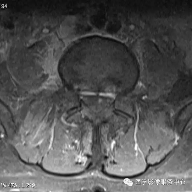 【病例】脊柱淋巴瘤1例MR影像表现 【病例】脊柱淋巴瘤1例MR影像表现