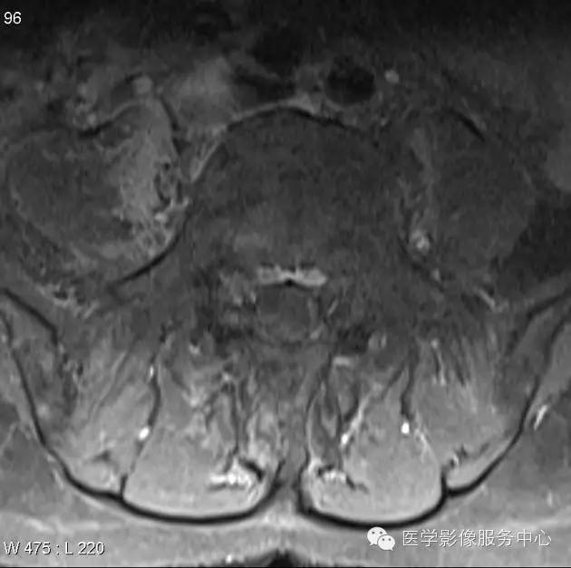 【病例】脊柱淋巴瘤1例MR影像表现 【病例】脊柱淋巴瘤1例MR影像表现
