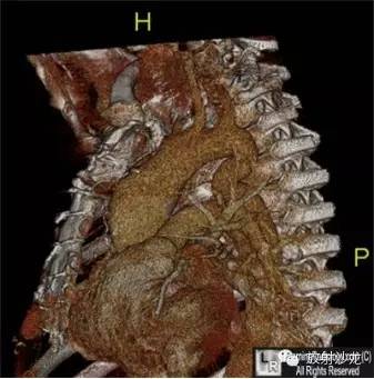 【病例】假性主动脉缩窄1例CT影像表现 【病例】假性主动脉缩窄1例CT影像表现