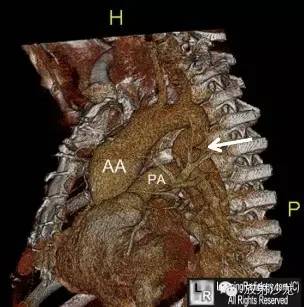 【病例】假性主动脉缩窄1例CT影像表现 【病例】假性主动脉缩窄1例CT影像表现