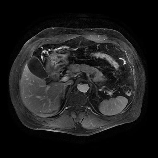 【病例】胰腺囊腺瘤1例MR影像表现