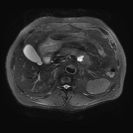 【病例】胰腺囊腺瘤1例MR影像表现