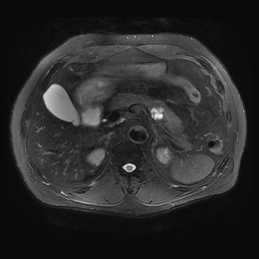 【病例】胰腺囊腺瘤1例MR影像表现