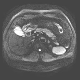 【病例】胰腺囊腺瘤1例MR影像表现