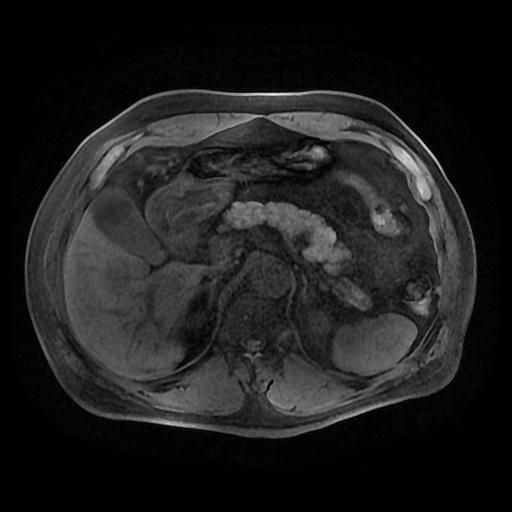【病例】胰腺囊腺瘤1例MR影像表现