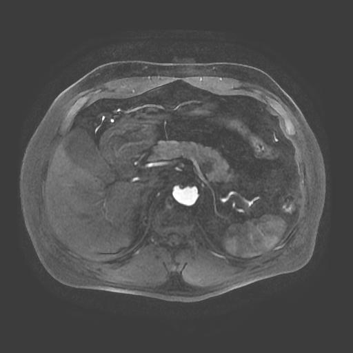 【病例】胰腺囊腺瘤1例MR影像表现