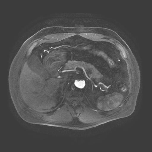 【病例】胰腺囊腺瘤1例MR影像表现