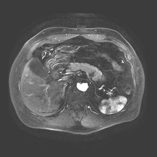 【病例】胰腺囊腺瘤1例MR影像表现