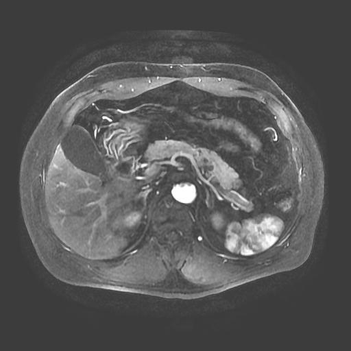 【病例】胰腺囊腺瘤1例MR影像表现