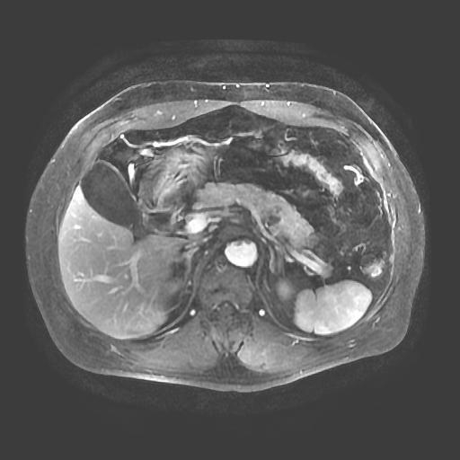 【病例】胰腺囊腺瘤1例MR影像表现