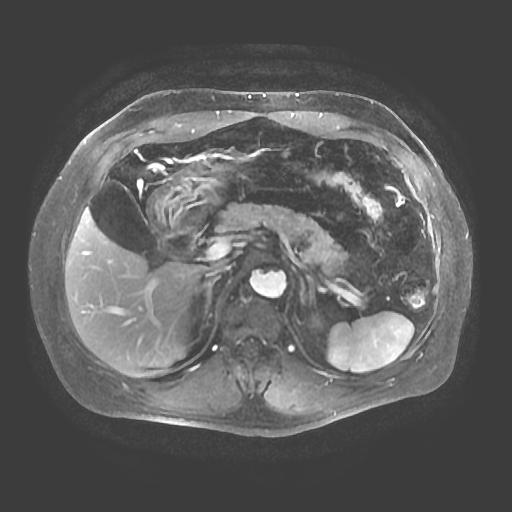 【病例】胰腺囊腺瘤1例MR影像表现